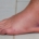 ¿Qué es un esguince de tobillo?
